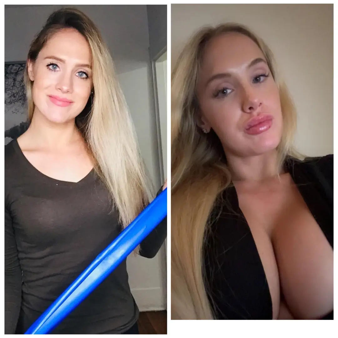 Freshly plumped lips and bigger tits coming sooner because more filled is always better