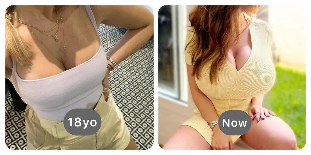 My serum-induced breast expansion and multistage growth has me jiggling more than jello
