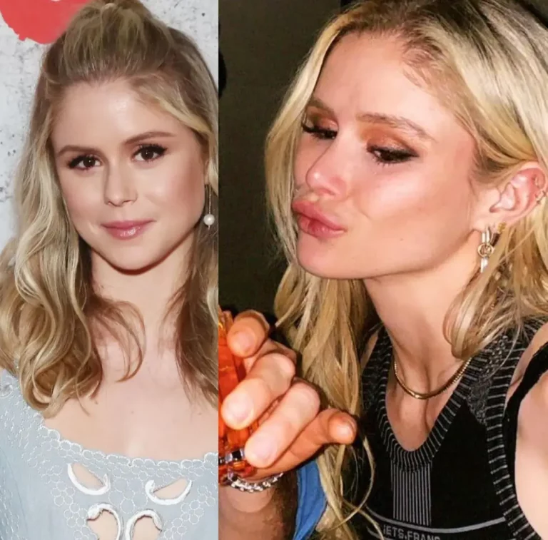 Bimbo Lips Transformation: Bleached, Plumped, and Perfected!