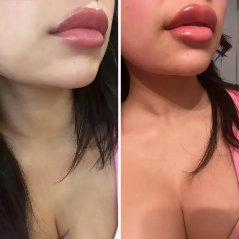 Juicy Lips Back in Action: Full Syringe for a Perfect Pout and Kissable Cheeks!