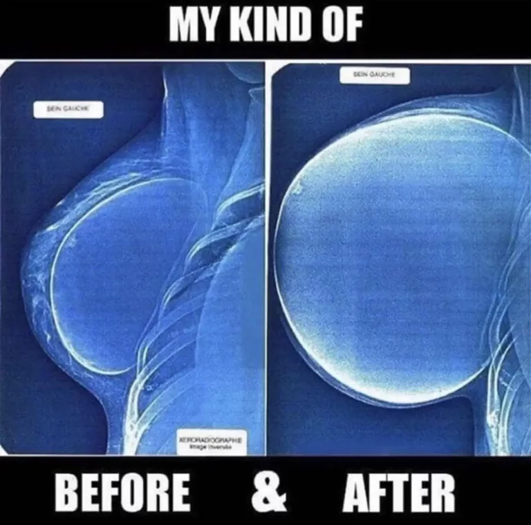 Salty & Stretched: My Boobs are 99% Saline Perfection!